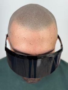 micropigmentación