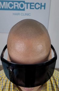 pigmentacion-cuero-cabelludo hombre