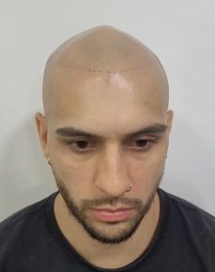 pigmentación estética