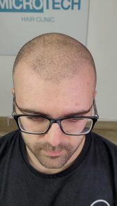 solución para alopecia