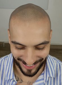 tratamiento capilar masculino
